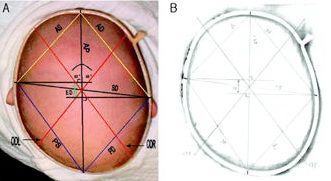 Plagiocephalometrie1.jpg